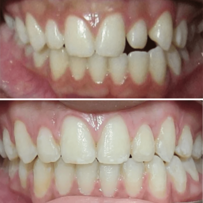 Dentista em Goiânia 6 espaço nos dentes