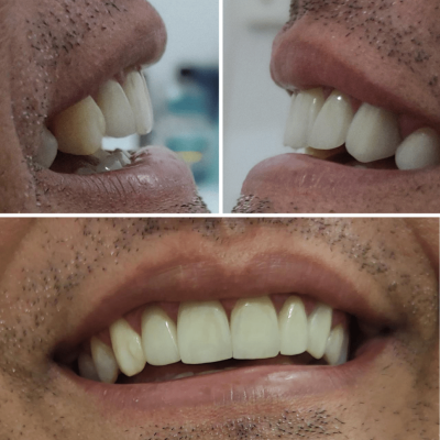 Dentista em Goiânia 5 coroas dentaria