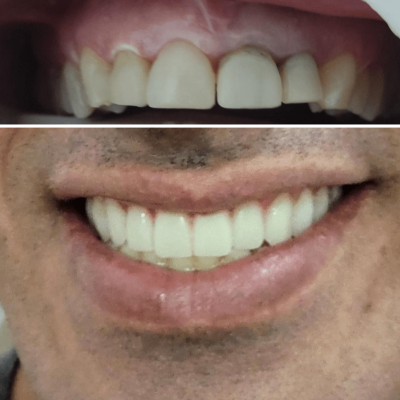 Dentista em Goiânia 4 protese dentaria