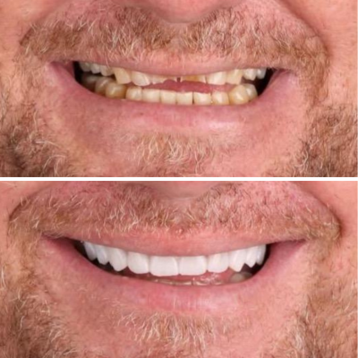 Dentista em Goiânia 3 reabilitacao-oral-completa.png